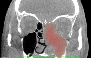 x-ray-image-of-sinus-tumor