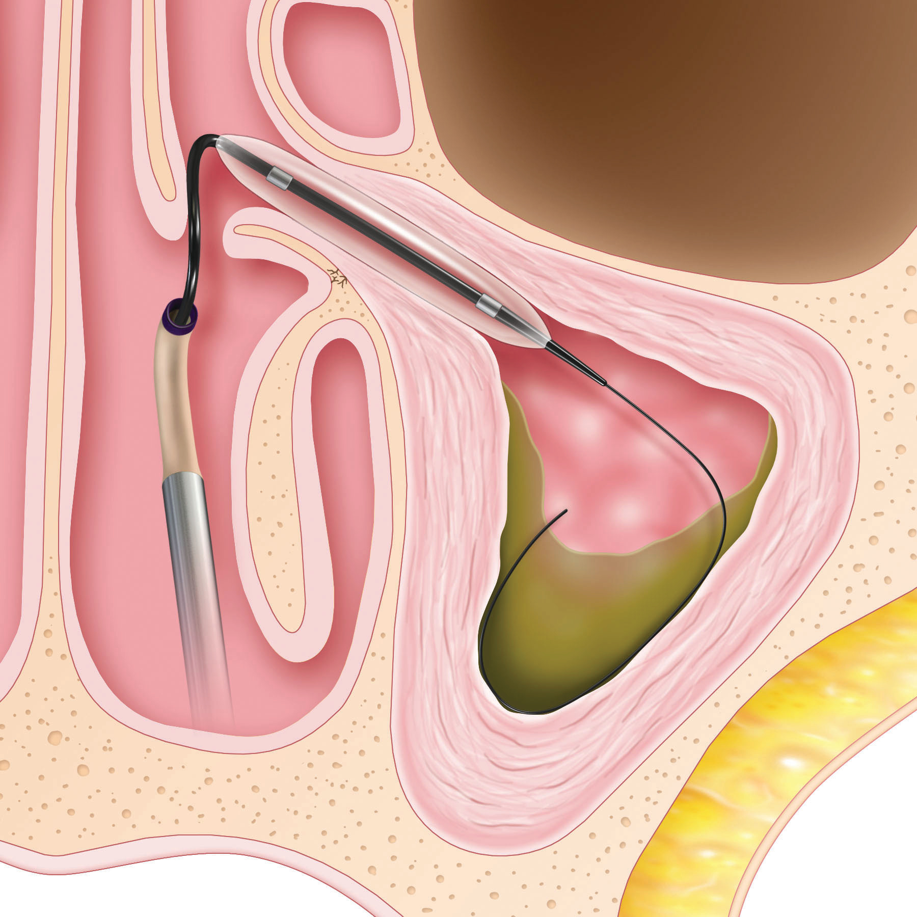 Graphic of sinus for step 1 of Baloon Sinuplasty.