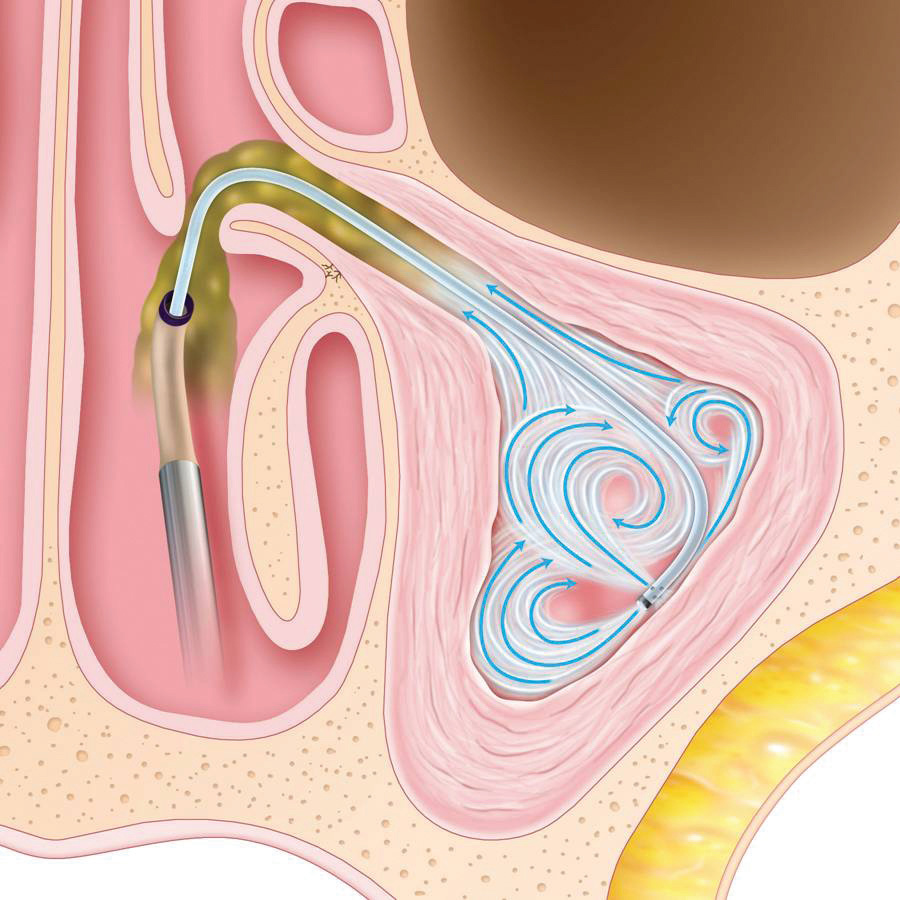 Graphic of sinus for step 1 of Baloon Sinuplasty.