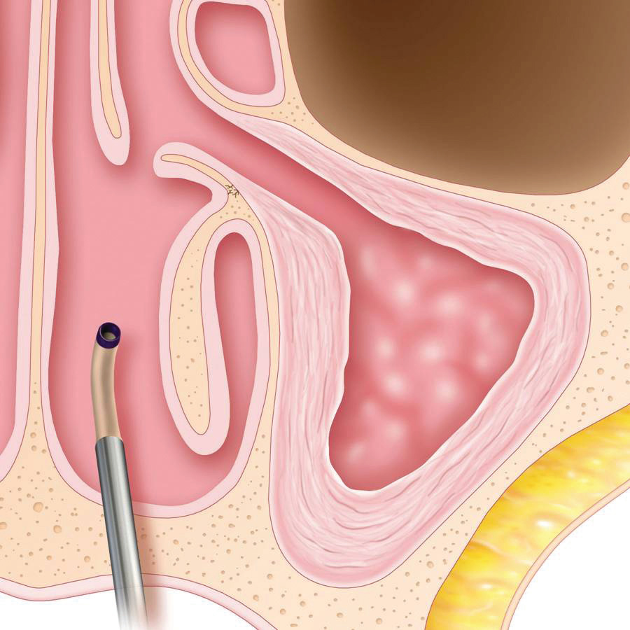 Graphic of sinus for step 1 of Baloon Sinuplasty.