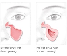 Diagram of clear sinus vs infected sinus